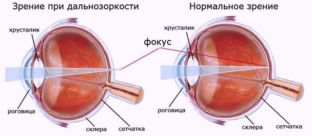 ТОП-9 глазных капель от дальнозоркости: обзор и цены
