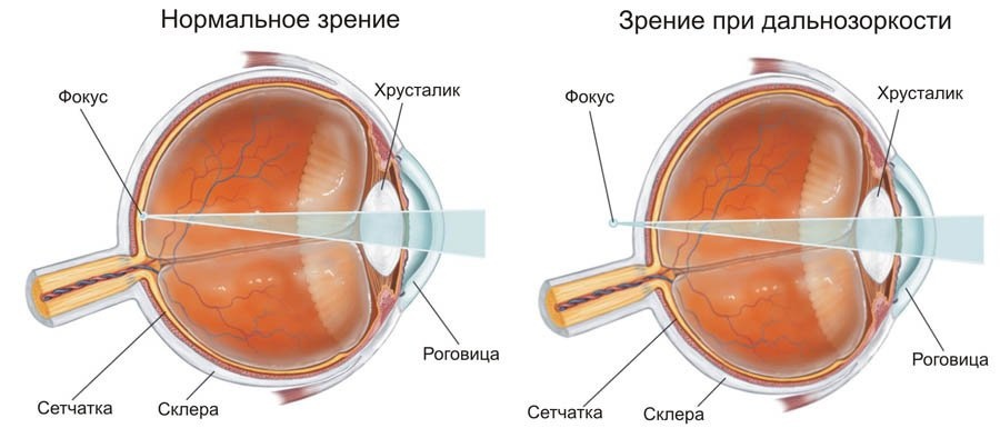 Дальнозоркость - плюс или минус
